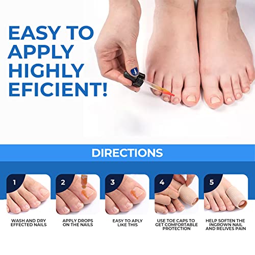 Капки TriOak За Премахване на Врастнали нокти На Краката, Определени За Премахване на Врастнали нокти На Краката, Коректор